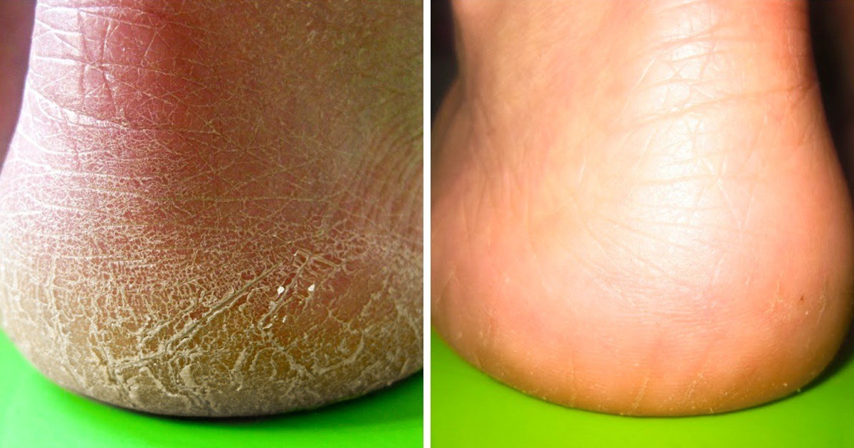 10 начина да се отървете от напуканите пети и да имате бебешки мека кожа на краката