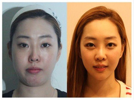 Пластичната хирургия в Корея: преди и след операциите (СНИМКИ)