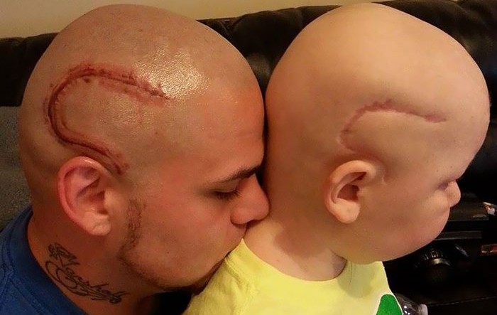 Баща татуира белега на сина си от мозъчна операция