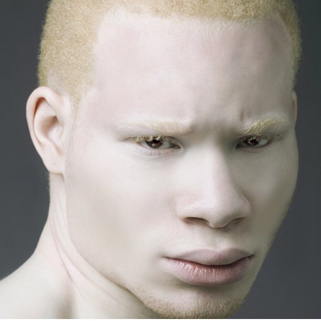 1. Албинизъм
