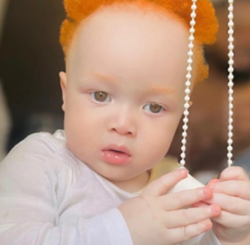Албинизмът: Пътешествие на открития