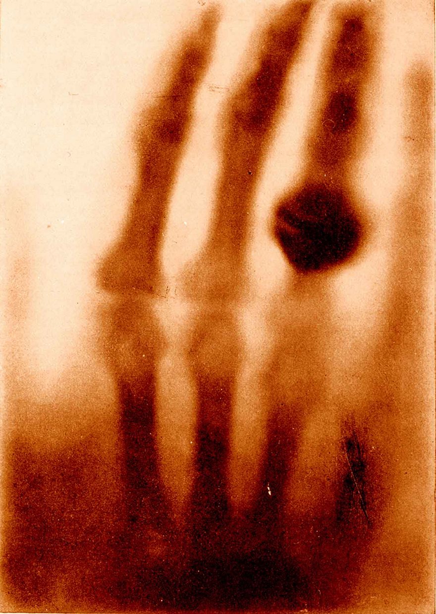 Ръката на Анна Рьонтген, 1895