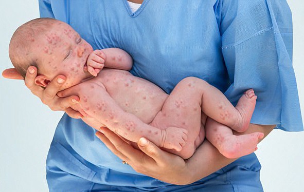 Нова епидемия от морбили удари Европа! Лекарите апелират родителите да ваксинират децата си