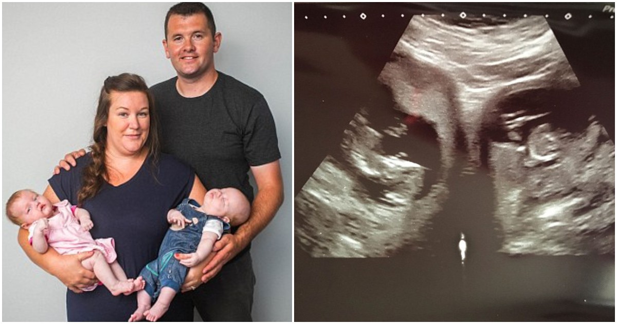 Медицинско чудо: Майка със сърцевидна матка роди съвсем здрави близнаци