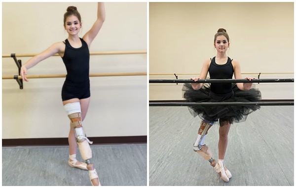 Едно истинско вдъхновение: Момичето с ампутиран крак, което не се отказа от мечтата си да стане балерина!