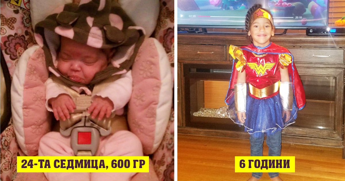 Преди и сега: Тези снимки на недоносени деца показват, че най-малките бебчета са най-упорити!