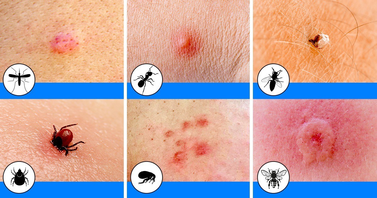 Полезно: Как изглеждат ухапванията от най-популярните насекоми през лятото