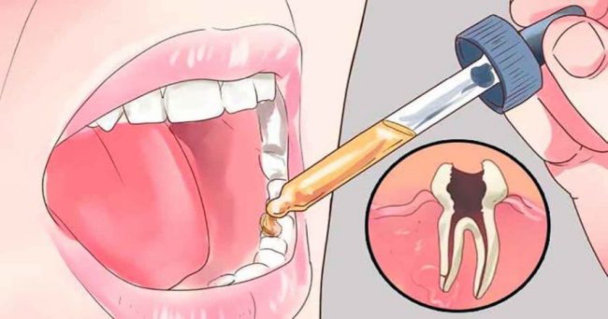 12 естествени средства срещу зъбобол