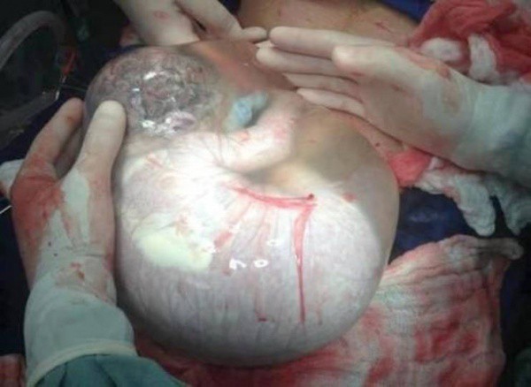 Редно или не: Лекар публикува снимка на бебе, родено в амниотичната си торбичка