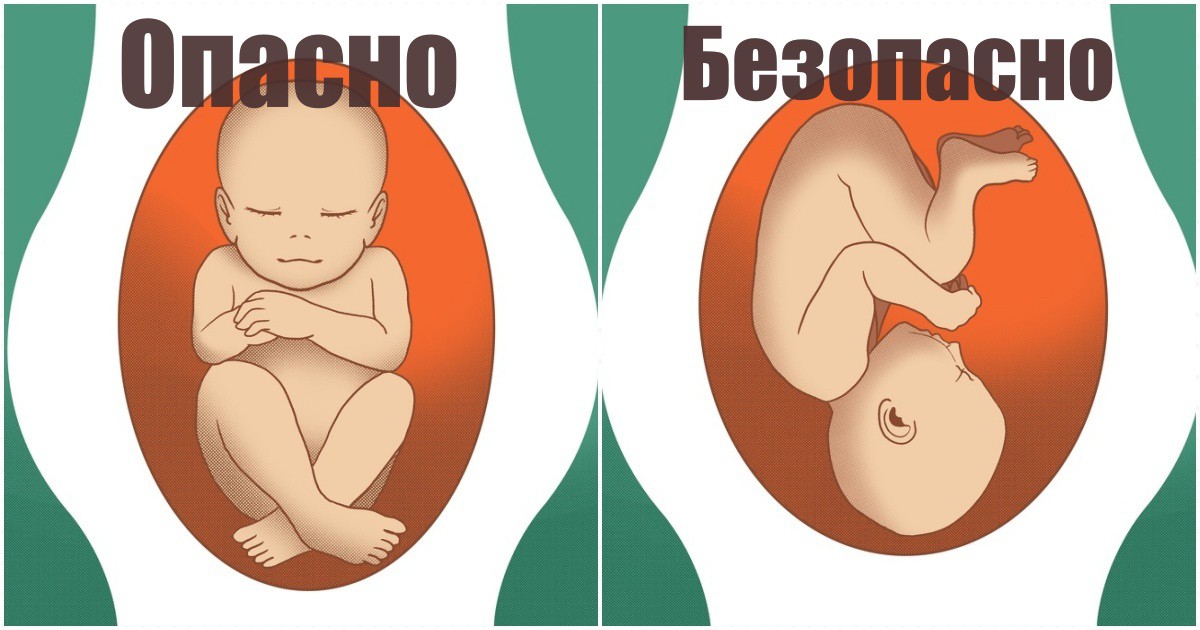 Какво означават различните пози на бебето по време на бременност