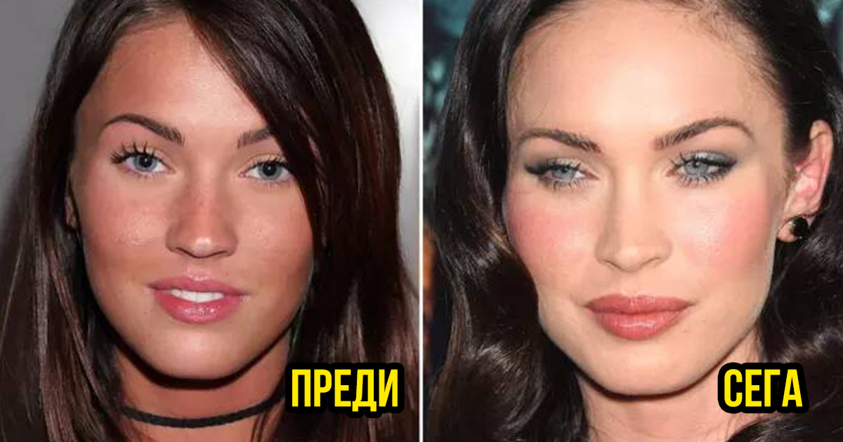 13 красавици преди и след пластичната хирургия
