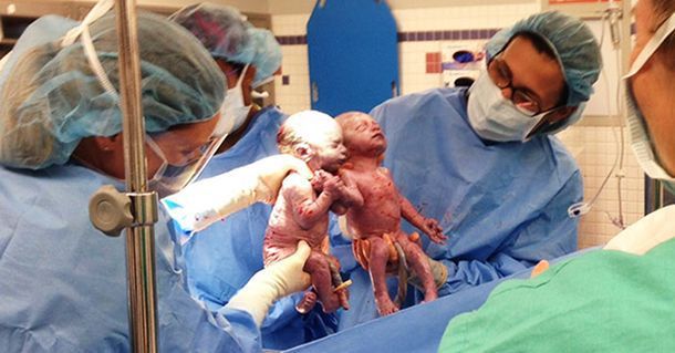 Спомняте ли си близначките, които се родиха хванати за ръка? Ето как изглеждат днес