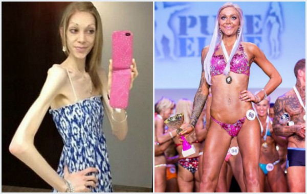 Невероятно: Момиче пребори анорексията и стана шампионка по бодибилдинг